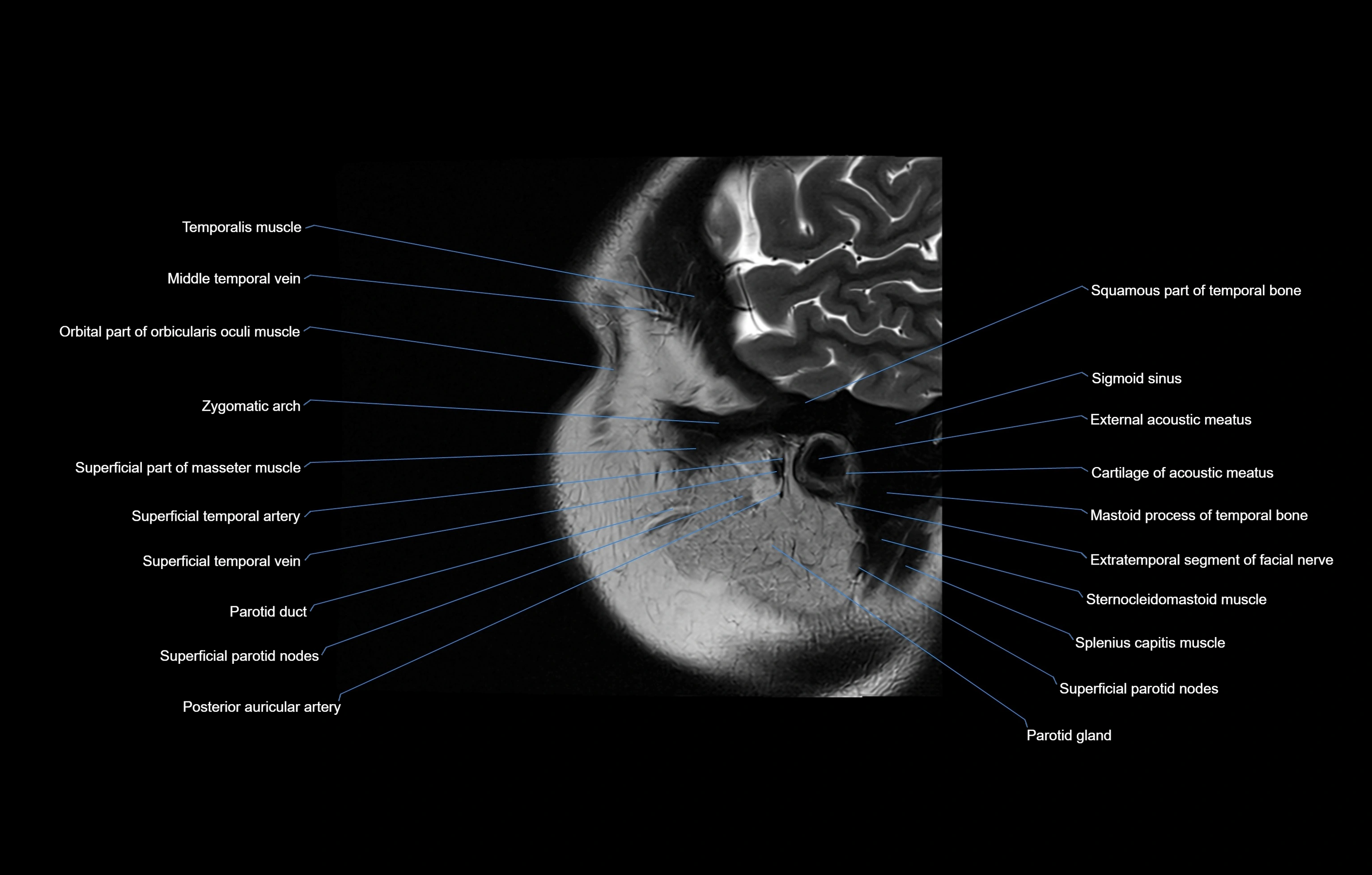 paranasal sinuses(PNS) MRI coronal  cross sectional anatomy 3T radiology  image-img-00001-00023.webp